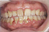 歯周内科治療：初診時（治療開始日）