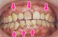 歯周内科治療：治療開始１週間後